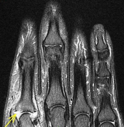 Figure 5 for case gout arthritis ( RID3567 )